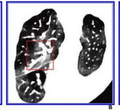 A，常规CT初发图像显示右肺上叶未见明显肺损伤(红框内)。B，与A图同时获得的CT电子密度谱图显示右肺上叶病灶(红框内)。C, A、B图像确认右肺上叶病变(红框内)后5天随访常规轴向胸部CT。