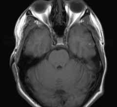 由于FND患者的常规检查，如临床磁共振成像(MRI)脑扫描和脑电图(EEGs)通常是正常的，目前没有基于大脑的这种疾病的标记物，只能通过体格检查的体征进行诊断