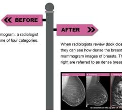 当放射科医生检查乳房x光片时，他们可以看到乳房的密度。下面是四张乳房x光照片。右边的两张图片被称为致密乳房。