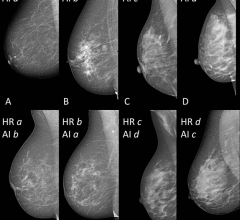 乳房X线学的中外侧倾斜观点与51至68岁之间的乳房密度不同。