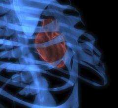 心血管计算机断层扫描学会(SCCT)发布了一份新的冠状动脉疾病专家共识文件