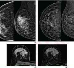 右乳房的41岁妇女患有侵入性导管癌（G2，Luminal B）