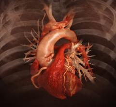 新型Aquilion One Genesis SP心脏CT系统使用人工智能来帮助重建低剂量的心脏CT图像。#SCCT2020