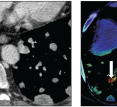根据ARRS的《美国x线学杂志》(AJR)，在常规胸部CT增强检查中，用于检测偶发性肺栓塞(iPE)的AI工具具有较高的NPV和中等的PPV，甚至发现了一些被放射科医生遗漏的肺栓塞