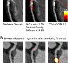冠状动脉CT血管造影和18F-NaF PET定量斑块分析在确诊冠状动脉疾病患者中的应用实例冠状动脉的混合CT血管造影和18F-NaF PET。(A)一名70岁男性，在LAD表现为弥漫性非钙化性疾病(中间红色区域)，PET显示LAD中18F-NaF摄取增加。(B) 59岁男性，轻度LCX动脉粥样硬化，CT血管显示高非钙化斑块负担(中间红色面板)