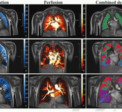 自由呼吸相位分辨功能肺(PREFUL)低场MRI 0.55T，轴向面计算参数，自动配准到呼气中位置，肺实质分割。从左到右，具有代表性的功能彩色编码图像显示健康对照组(上一排，7岁男性)的通气缺陷(VDP，蓝色)、灌注缺陷(QDP，红色)、通气/灌注(V/Q匹配，绿色)、通气/灌注缺陷(V/Q缺陷，紫色)