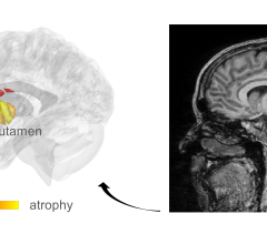 MRI对早期PD患者显微结构变化的检测。与健康对照组相比，黄色区域是PD患者显示组织损伤的区域。图片由Mezer实验室/希伯来大学提供
