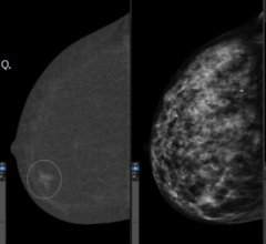 左:CEM检查的重组图像显示碘的摄取。右图:标准数字乳房x光片。