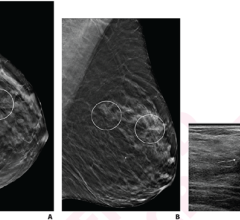 对于在数字乳房断层扫描(DBT)中发现的多发性结构扭曲(AD)患者，考虑到个别患者AD的病理诊断差异，所有区域的活检可能是必要的