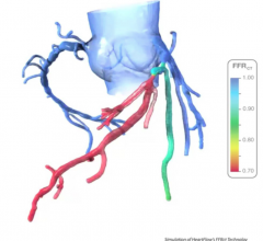HeartFlow的FFR-CT基于心脏CT扫描分析患者冠状动脉血管堵塞严重程度的一个例子。