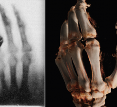 左图是1895年伦琴妻子的第一张x光照片。右图，2015年使用新型机器人数字放射术(DR) x射线系统对一只手进行锥束CT三维重建。
