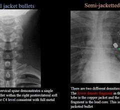 左：颈椎的AP X射线照相表现出右后外侧软组织C4水平的单密度明确的子弹，与全金属夹克子弹相处：两种不同的弹道材料。左上叶中的低密度碎片是铜夹克，高密度金属碎片是铅评分，与半剥布的子弹相处。