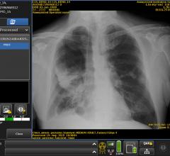 FDA批准GE医疗集团危重护理套件胸部x光人工智能