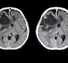 超过一定大小的个体脑转移瘤通常在显微外科切除的帮助下通过手术切除。相比之下，在立体定向放射外科(SRS)中，通常使用钴60- γ辐射源进行单次高剂量靶向辐射治疗。