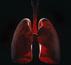结核病是一种传染性肺部疾病，每年全世界有一百多万人死于结核病。