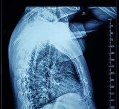 虽然肺癌患者的肿瘤受到了高剂量的辐射，但通过保留大部分食道的技术进行治疗的患者并没有出现严重的食道炎症