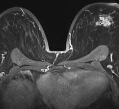 乳腺MRI与tumoral lession左胸上,轴向视图。