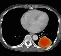 来自双模扫描仪的PET-CT联合注册研究图像。肝、肺多发转移病灶患者。PET数据叠加CT扫描轴向切片通过肺转移