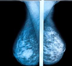 根据瑞典隆德大学(Lund University)的一项大型研究，与传统乳房x光检查相比，3d乳房x光检查减少了常规筛查之间诊断出的乳腺癌病例数量。研究结果发表在《放射学》杂志上。