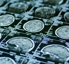 神经性脑标记物可能检测精神障碍的风险