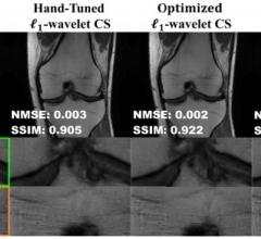 明尼苏达大学双城分校的研究人员发现了一种方法，可以提高传统磁共振成像(MRI)重建技术的性能，使磁共振成像速度更快，而不依赖于使用更新的深度学习方法。图片来源:明尼苏达大学智能医学成像和图像处理实验室