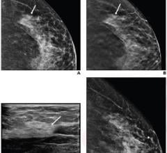 57岁女性，接受筛查性乳房x光检查:A为数字化，B为断层合成，颅侧图像显示1.8厘米不对称(箭头)，左乳侧，BI-RADS为0。C，超声左乳评估显示正常的纤维腺组织(箭头)被认为与乳房x线摄影发现相关。D，侧位显像中不对称性被消除。前深度12点钟位置有金属BB标记。最终评估图片由ARRS提供