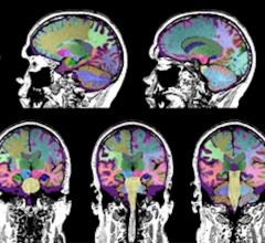 Neuroreader软件程序量化了TBI研究参与者的脑容量