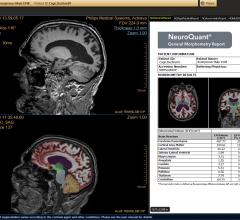 特拉华成像网络现在提供NeuroQuant大脑成像MRI软件