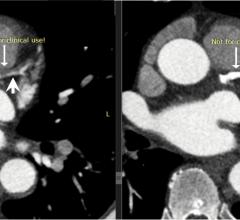 梅奥诊所新型第三代光子计数CT研究扫描仪固有的光谱能力，通过减少来自密集冠状动脉钙化(箭头)的明亮信号，可以清晰地显示冠状动脉腔的完整部分(箭头)。