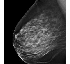 #SBI #NCoBC Studies presented at two leading breast imaging conferences demonstrate ProFound AI helps radiologists identify normal mammograms and those with increased likelihood of malignancy with precision