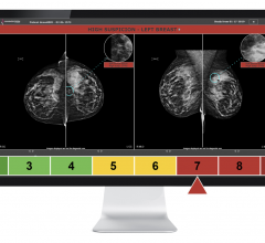 这项尖端技术帮助放射科医生解读筛查性乳房x光片，使他们能够更早、更准确地诊断乳腺癌
