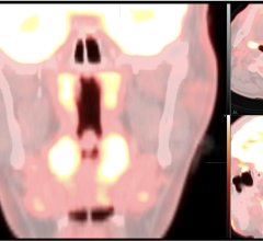 工作组成员最近在FDG PET/CT或FDG PET/MR上观察到不寻常的成像模式，这可能是由于COVID-19感染。