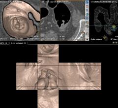 CT结肠镜检查的保险范围增加筛查的可能性