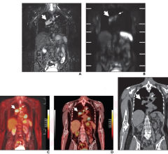 根据参考标准诊断，TNM分期为IIIA (T3N2M0)，退伍军人管理局肺癌研究组分期为LS。冠状面(A) STIR图像和(B)来自全身MRI的DWI图像。