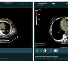 Zebra Medical Vision现在为其心脏解决方案HealthCCSng提供人工智能(A)医学成像分析，这使CT扫描中的冠状动脉钙(CAC)量化成为偶然发现。