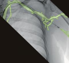 Ziehm移动c臂系统的三维血管测绘技术实例。