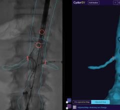 Cydar EV Maps协助规划、实时指导和血管内手术的术后复查。