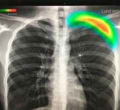 这是一张由人工智能(AI)自动检查的肺部x光片，以识别颜色编码区域的肺萎陷(气胸)。Lunit的这款人工智能应用程序正在等待FDA的最终审核，并计划集成到几家供应商的移动数字放射成像(DR)系统中。富士胶片在2019年RSNA上展示了该软件集成到其移动x光系统中。通用电气医疗保健公司的移动r=ray系统有自己的该软件版本，并于2019年获得FDA批准。# RSNA #