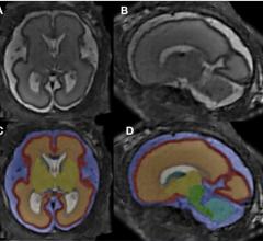 图1所示。MRI超分辨率重建和基于图谱的组织分割。(A, B) 26+6 GW胎儿轴向和矢状面的后处理MRI超分辨率重建。(C, D) Respective manually corrected atlas-based tissue segmentation.