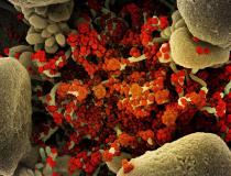 从患者样本中分离出的被SARS-CoV-2病毒颗粒(橙色)严重感染的凋亡细胞(褐色)的彩色扫描电子显微图。图片摄于马里兰州德特里克堡国家过敏和传染病研究所(NIAID)综合研究设施(IRF)。图片由NIAID提供