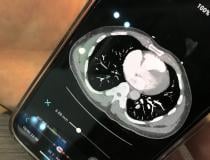 Aidoc的人工智能肺栓塞反应小组(PERT)激活应用程序展示了如何在智能手机上查看CT扫描。页面底部的橙色点标记的关键切片是人工智能检测到的肺栓塞。
