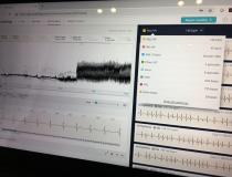 Cardiologs公司今天在2019年HIMSS上为diaic演示了其人工智能心电图解释软件。它具有欧洲CE标志和FDA许可，可以从各种ECG源检测各种心律失常，从1导至12导。人工智能使用来自心电图(照片中模糊的地震波形)的数字数据直方图和节奏条来解释检查。它使用超过100万个心电图进行模式识别训练。