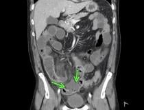 肠系膜上动脉血栓形成并发肠缺血和穿孔，54岁男性，因腹痛就诊于急诊室，被诊断为COVID-19。腹部和骨盆CT增强图像显示小肠粘膜强化(绿色箭头)。