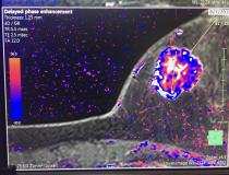 本周，在2019年HIMSS大会上，富士胶片的Synapse 3D放射学软件发布了五款新的高级可视化应用程序。这些图像来自一种新的磁共振成像(MRI)乳腺分析软件。彩色动力学曲线阈值视图显示了钆造影剂的冲洗和冲洗，以确定肿瘤是良性还是癌症。