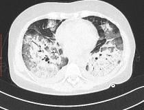 as肺CT横切面显示肺部重区冠状病毒肺炎。心形在图像的中央。盖蒂图片社