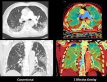 老年患者入院，其症状与COVID-19一致。由于病人有干咳和呼吸短促，要求做CT。图像在Philips IQon光谱CT扫描仪上完成。页面左侧显示常规CT，同一切片上显示Z有效光谱成像，显示了新冠肺炎的区域，包括在常规CT上不明显的区域。