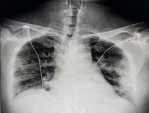 来自德克萨斯州的一名COVID-19患者的数字x光胸片显示，COVID-19肺炎沿胸壁两侧。 Photo from radiologist John Kim, M.D.