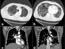 COVID-19导致一些患者血液凝结，这可能导致肺栓塞，如图所示，摘自《放射学》杂志。阅读更多关于这种COVID并发症的信息，并找到关于这些图像的更多信息。