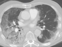 计算机断层扫描(CT)显示肺部的COVID-19肺炎，典型的COVID位置可见磨砂玻璃不透明(GGOs)，附着在肺壁的下部。通过视频查看整个CT数据集。图片由Margarita Revzin等人提供。