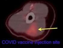 32岁女性，左臂18-FDG PET/CT显示新冠疫苗注射部位高代谢性三角形炎症(箭头)。阅读原文。图片由RSNA提供。